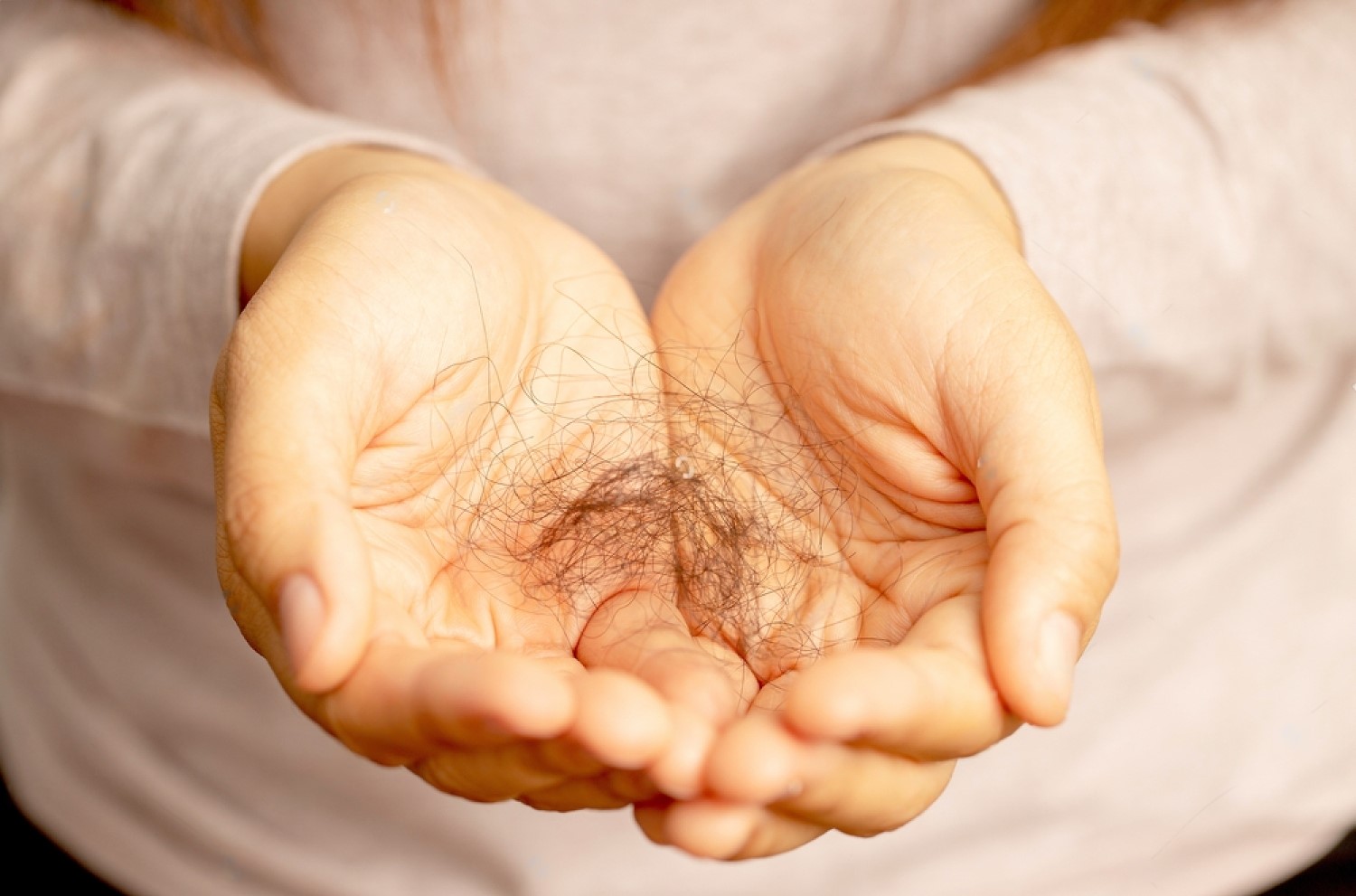 Is Seborrheic Dermatitis Hair Loss Permanent