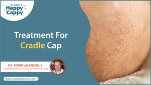 Treatment For Cradle Cap