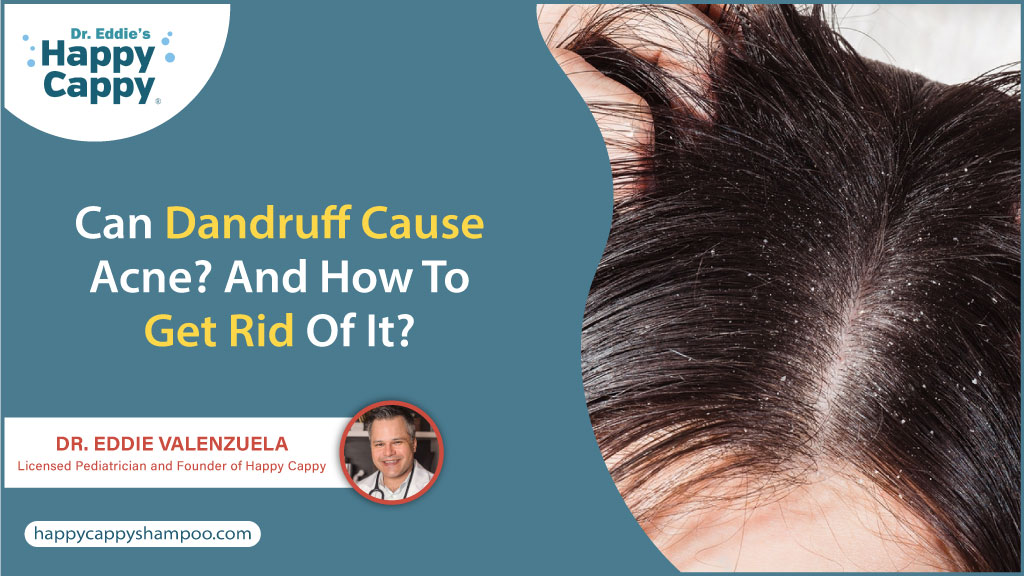 Can Dandruff Cause Acne? And How To Get Rid Of It?