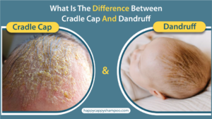 Difference Between Cradle Cap And Dandruff