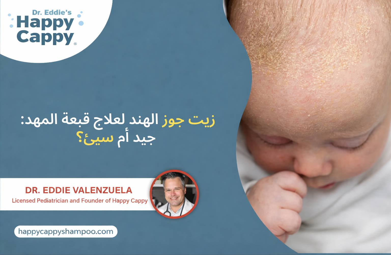 زيت جوز الهند لعلاج قبعة المهد