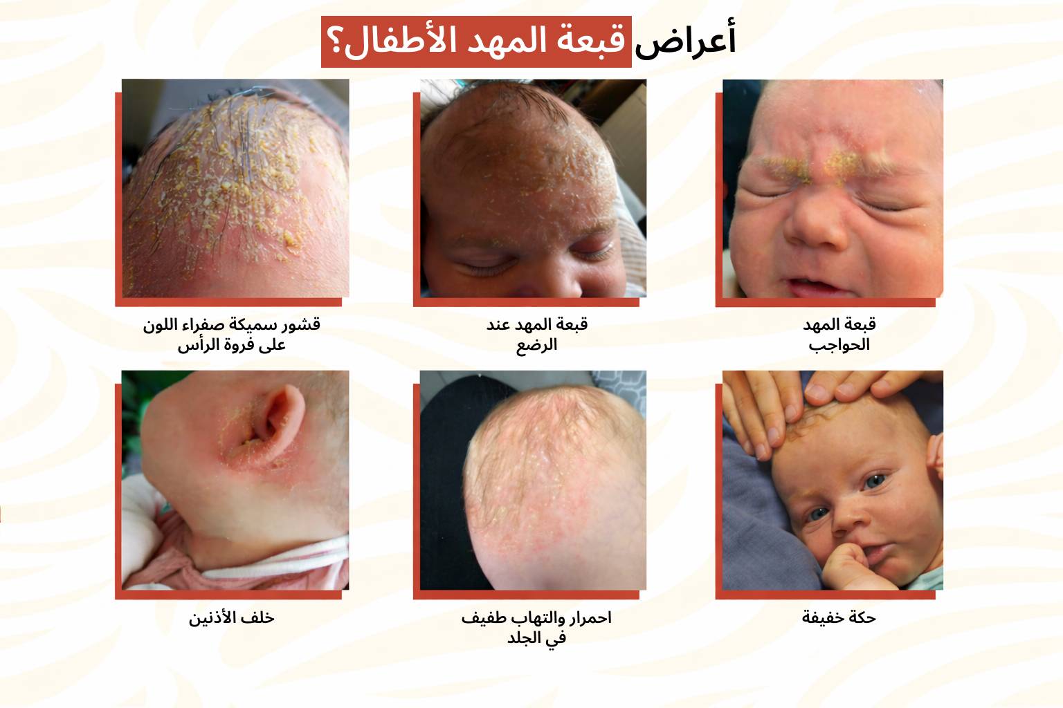 أعراض قبعة المهد الأطفال