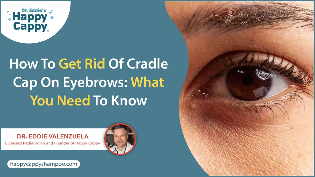 Cradle cap on eyebrows discount