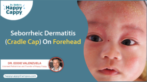 Seborrheic Dermatitis (Cradle Cap) On Forehead