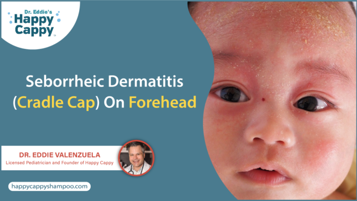 Seborrheic Dermatitis Cradle Cap On Forehead Happy Cappy