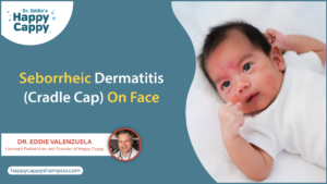 Seborrheic Dermatitis (Cradle Cap) On Face