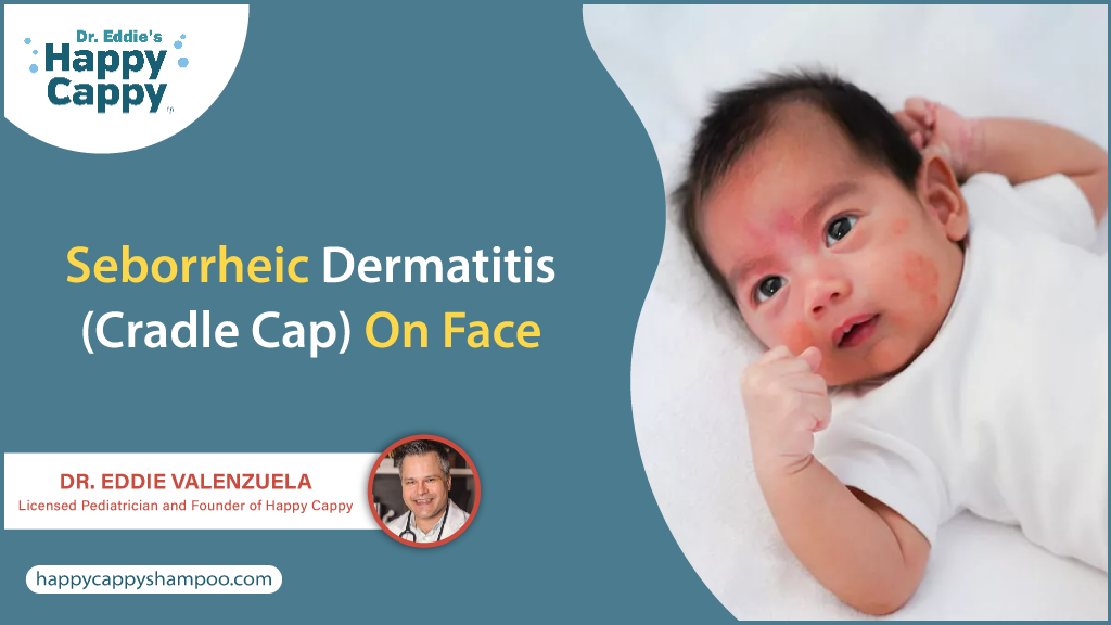 Seborrheic Dermatitis (Cradle Cap) on Face