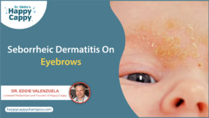 Seborrheic Dermatitis on Eyebrows