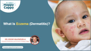 What Is Eczema (Atopic Dermatitis)?