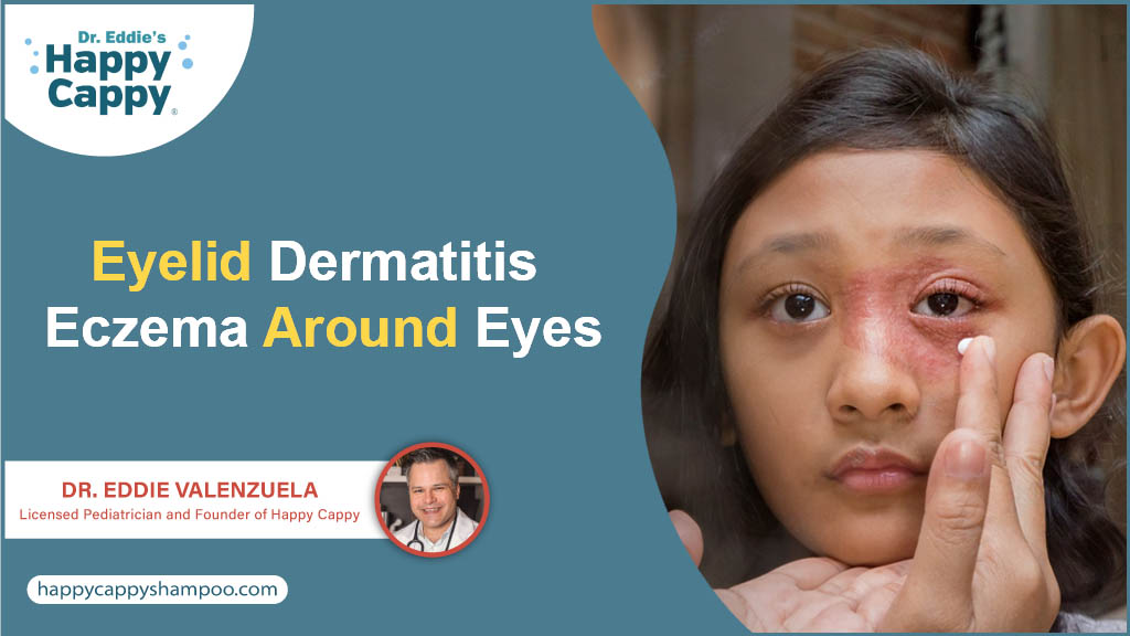 Eyelid Dermatitis Eczema Around Eyes Dr. Eddie's Happy Cappy