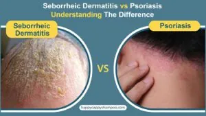 Seborrheic Dermatitis vs Psoriasis: Understanding The Difference