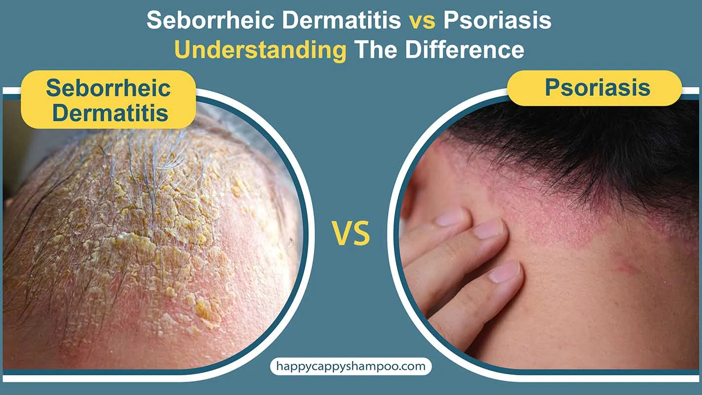 Seborrheic Dermatitis Vs Psoriasis Understanding The Difference