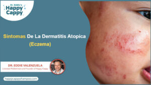 Sintomas De La Dermatitis Atopica (Eczema)