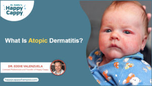 what is atopic dermatitis