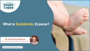 What is dyshidrotic eczema
