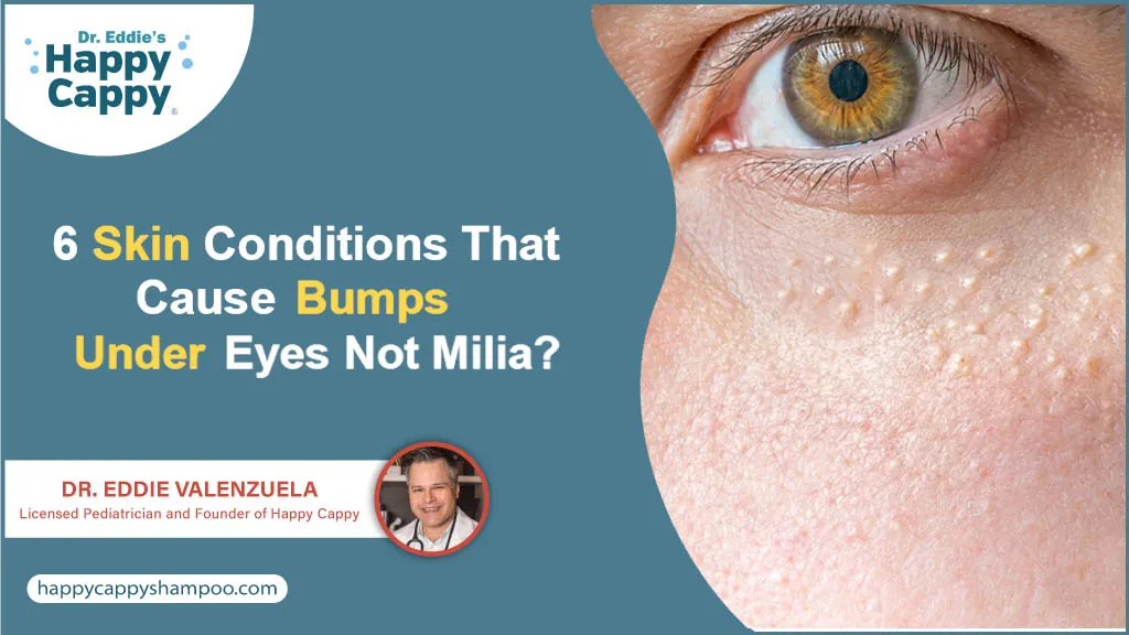 6 Skin Conditions That Cause Bumps Under Eyes Not Milia?
