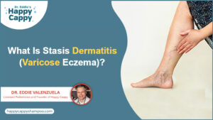 What Is Stasis Dermatitis (Varicose Eczema)? 