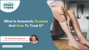 What Is Asteatotic Eczema And How To Treat It