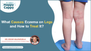 Eczema on Legs
