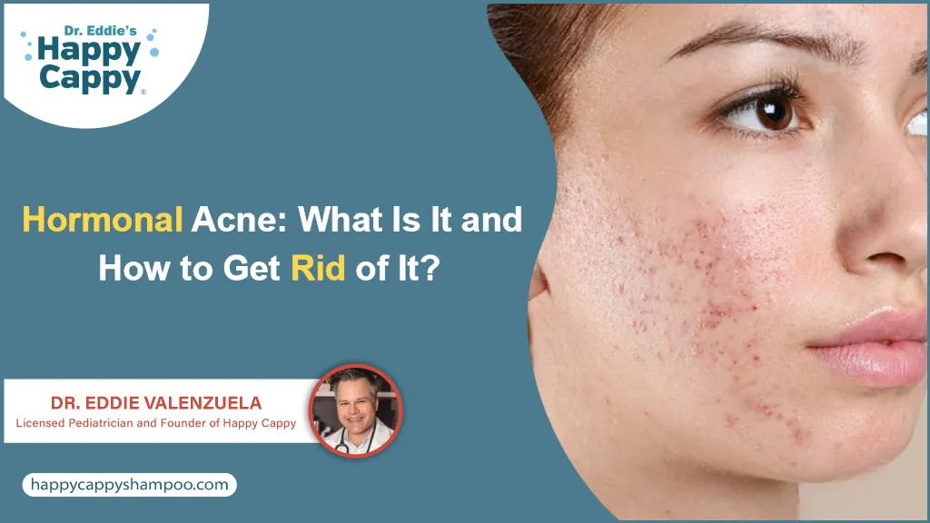 hormonal acne what is it and how to get rid of it