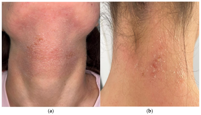 Atopic dermatitis with redness and scale on the front and back of the neck in two adolescent patients.