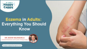 Eczema in Adults: Everything You Should Know.