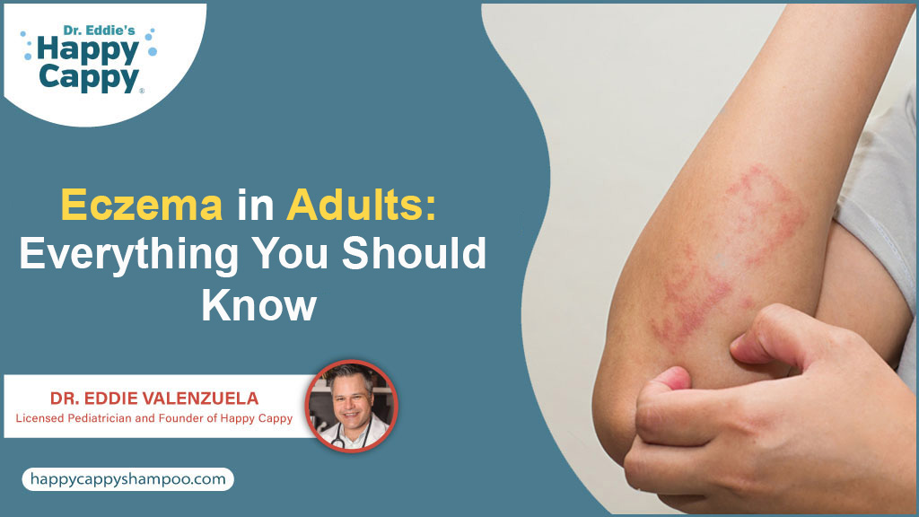 Eczema in Adults: Everything You Should Know - Happy Cappy