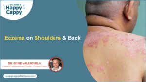 Eczema on Shoulders & Back