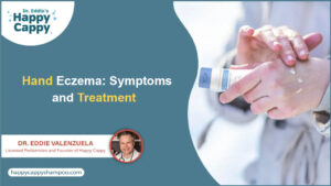 Hand Eczema Symptoms and Treatment