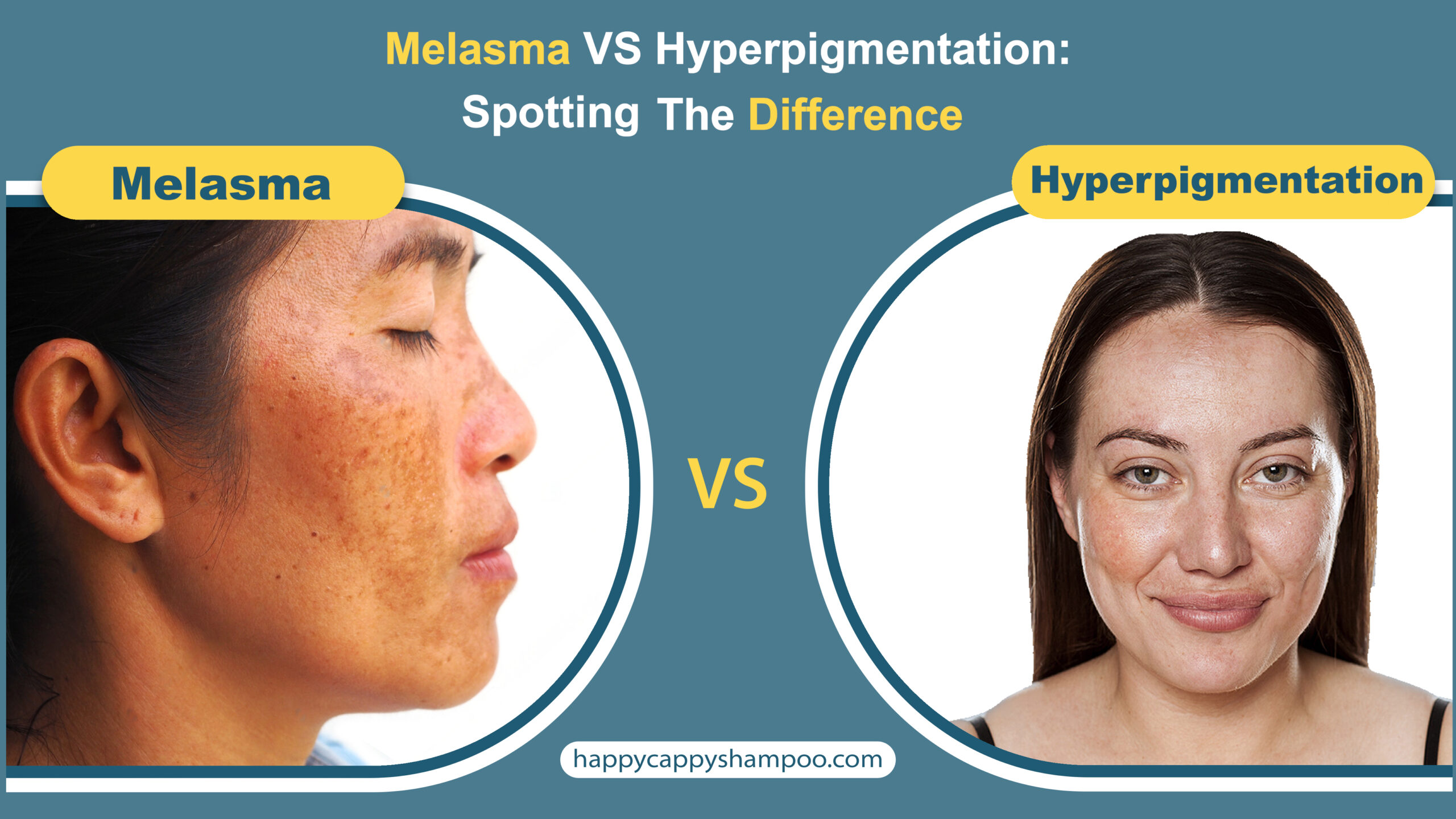 Melasma VS Hyperpigmentation: Spotting The Difference