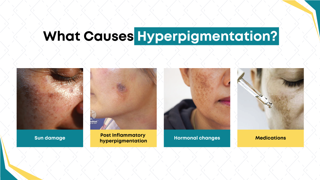 What Causes Hyperpigmentation