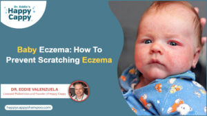 Baby Eczema: How to Prevent babies from Scratching Eczema