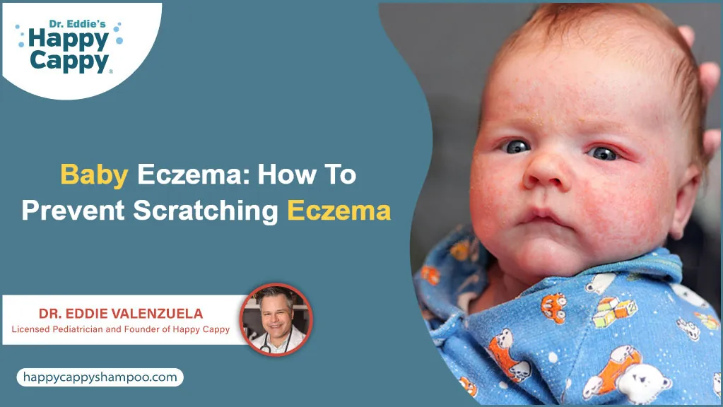 Baby Eczema: How to Prevent Scratching Eczema? - Happy Cappy