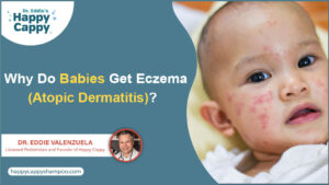 Why Do Babies Get Eczema (Atopic Dermatitis)