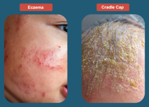 cradle cap or eczema