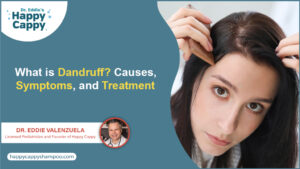 What is Dandruff Causes Symptoms and Treatment
