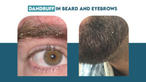 Dandruff in Beard and Eyebrows