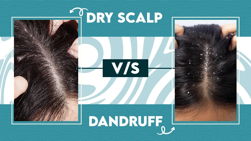 Dandruff vs Dry Scalp