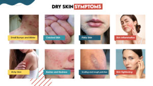 Dry Skin Symptoms