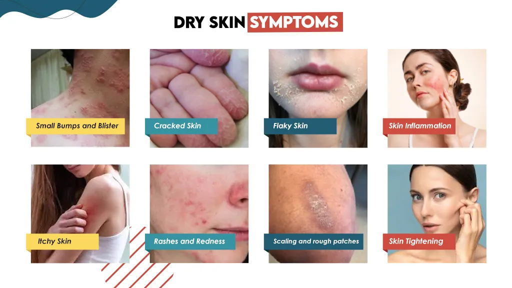 Dry Skin Symptoms