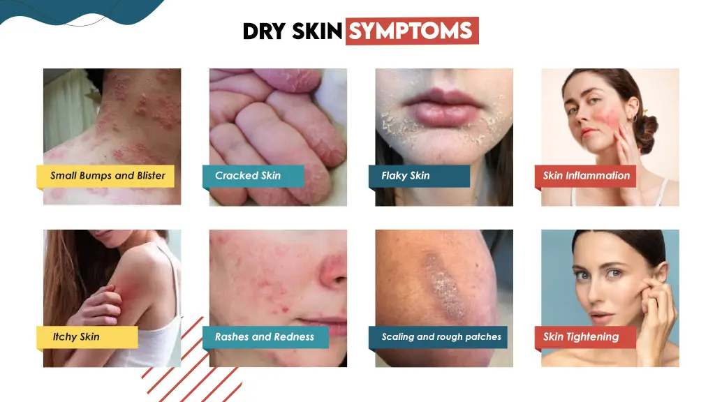 Dry Skin Symptoms Dry Skin Symptoms