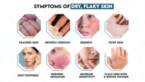 Symptoms Flaky Skin