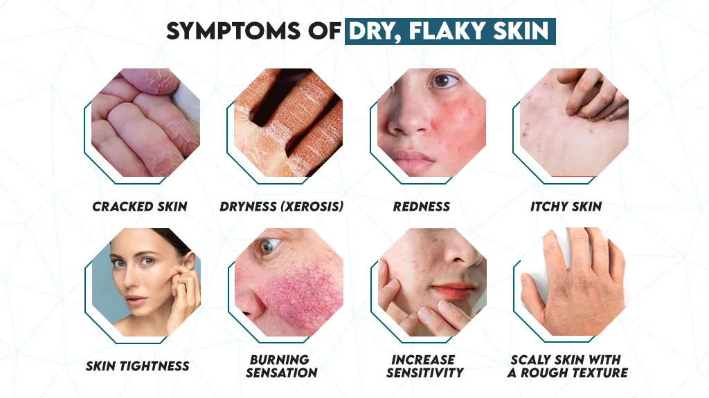 Symptoms Flaky Skin