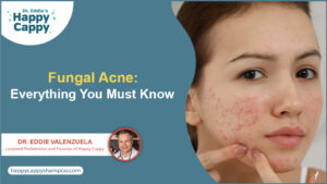 What is Fungal Acne?