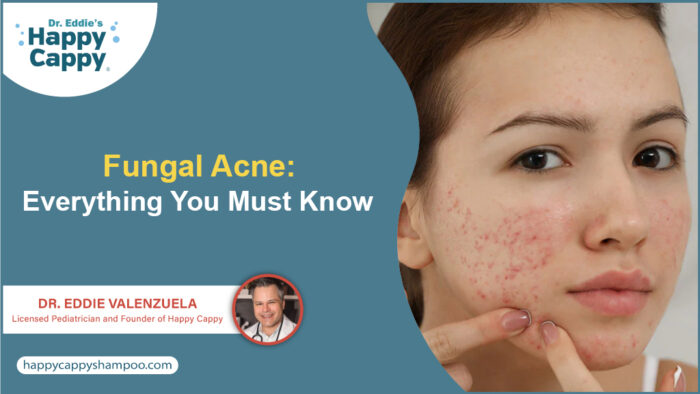 Fungal Acne: Everything You Must Know - Happy Cappy