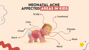 Neonatal Acne Symptoms