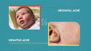 Neonatal Acne Vs Infantile Acne