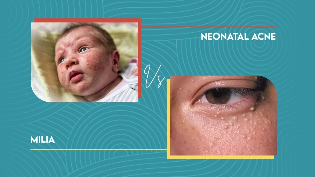 Neonatal Acne Vs Milia