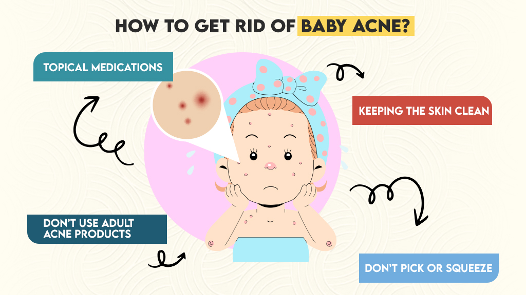 Baby Acne Treatment