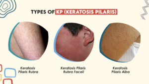 Types of Keratosis Pilaris